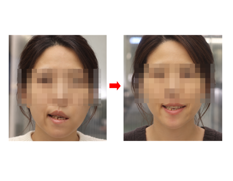 구안와사 침치료? 2년간 어디서도 낫지 않던 30대 환자 회복 사례