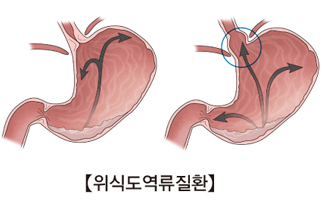 속 쓰림의 진짜 범인은 위산일까? 역류성 식도염의 숨은 원인