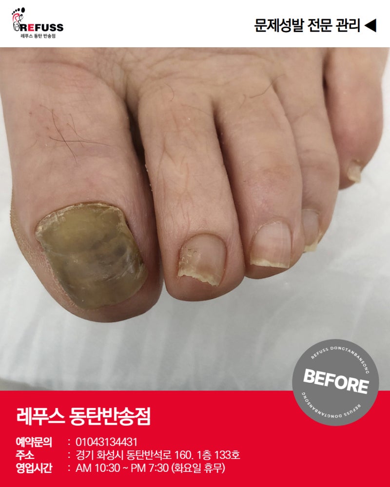 반송동 발톱무좀, 레푸스동탄반송점 나에게 맞는 관리를 찾아야하는 이유