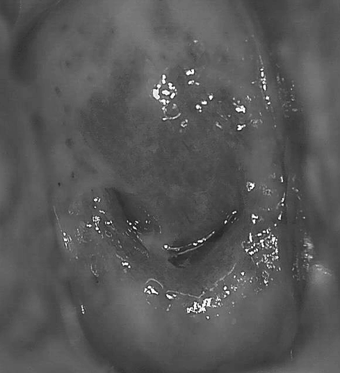 자궁경부이형성증 CIN1, CIN2, CIN3 치료를 종결하는 기준은?