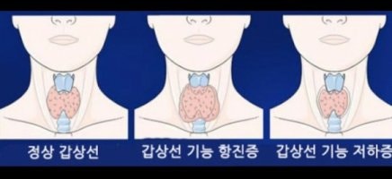 갑상선기능검사의종류와비용안내 - 금천구시흥동유방갑상선