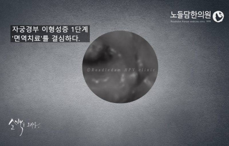 자궁경부이형성증 1단계(CIN1), 왜 치료의 골든타임일까요?