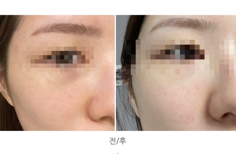 부산 편평사마귀 제거 고민하다 직접 받아봄 | 통증, 딱지, 회복과정 후기