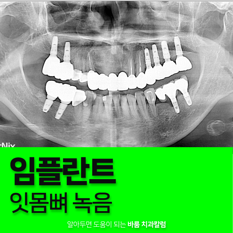 임플란트 주변 잇몸뼈가 녹는 이유