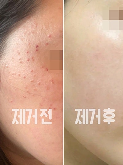 편평사마귀 제거 후 관리 7일만 이렇게 해보세요! 제발!