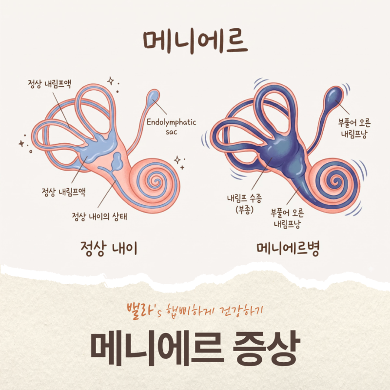메니에르 증상 원인부터 진단까지, 밝혀진 것과 아직 모르는 것