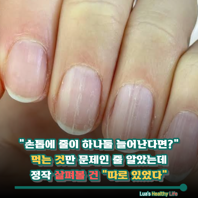 "손톱에 세로줄이 왜 갑자기 늘었지?" 배달음식 때문이 아니었다고? 정작 확인할 건 "이것"