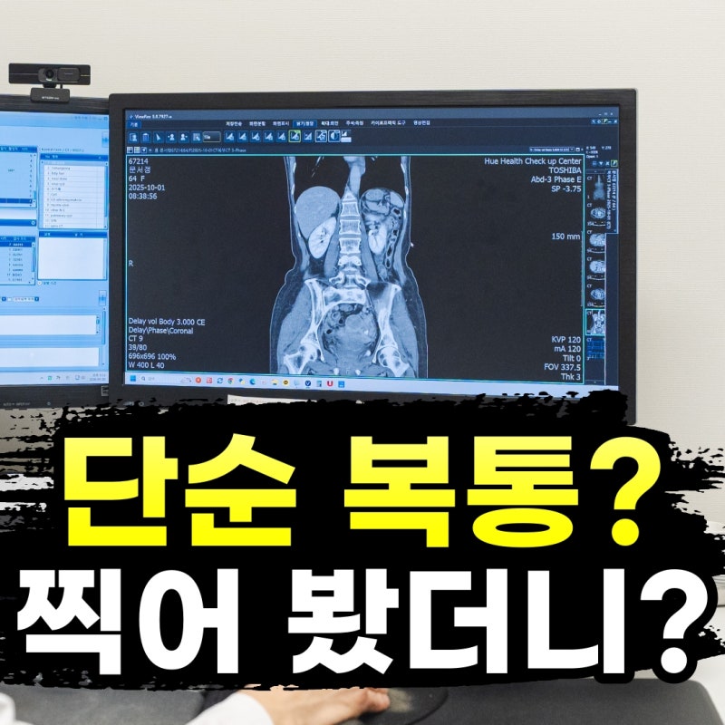 복부 CT 검사, 단순 복통인 줄 알았는데 충수염이었다면?