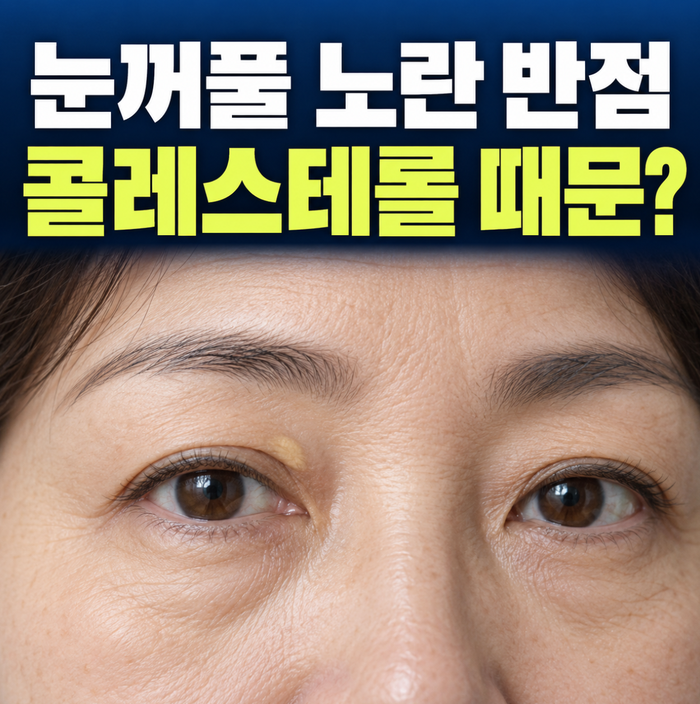“눈꺼풀에 노란 반점 생겼다면?” 고지혈증 의심될 때 확인할 몸의 변화 5가지