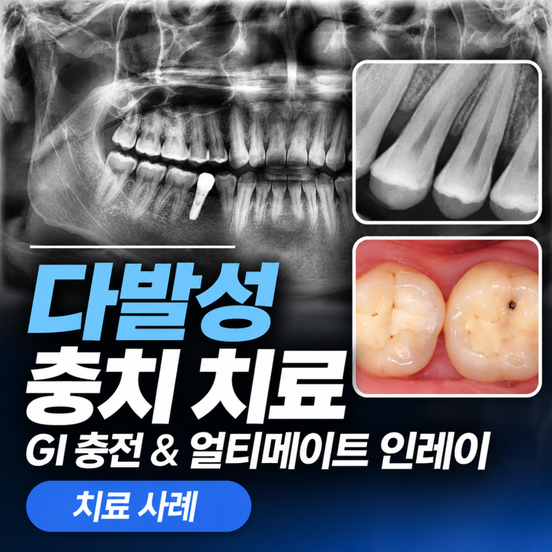 충치가 여러 개 발견됐다면? GI 충전 · 얼티메이트 인레이로 치료한 20대 남성 사례