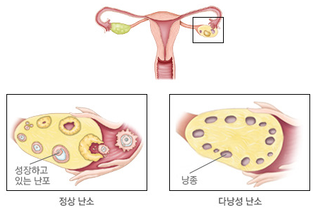 이노시톨이 왜 주목받을까, 다낭성·다이어트 효능 근거 정리