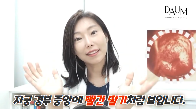트리코모나스 질염 원인과 치료, 성관계로 감염될까요?