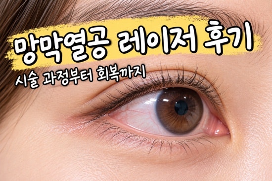 망막열공 레이저 후기 증상, 통증정도와 시술 과정, 주의사항 총정리