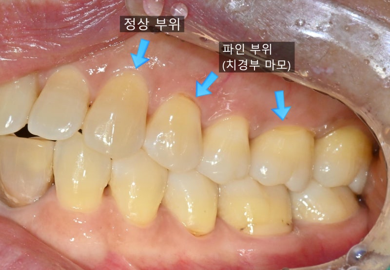[마곡 치과] 양치할 때마다 치아가 시려요 - 치경부 마모, 치아 뿌리 파임, 간단한 레진 치료....