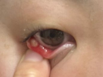 다래끼 째고 온 후기｜대전 맑은눈안과의원, 속다래끼 절개 과정부터 통증까지… 진짜 아팠....
