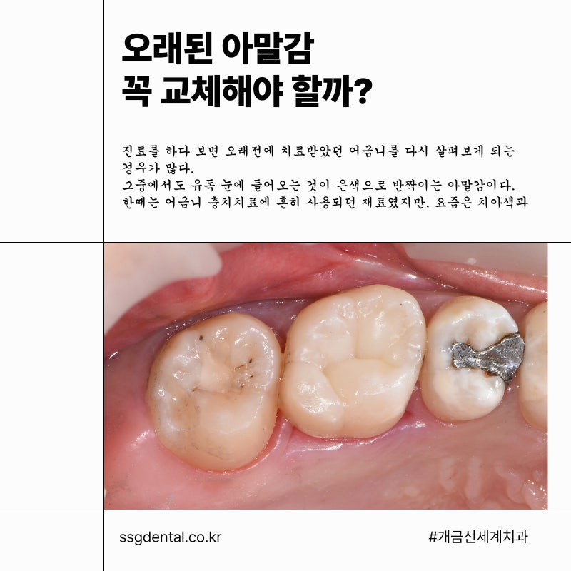 주례치과 어금니 레진, 오래된 아말감 꼭 교체해야 할까