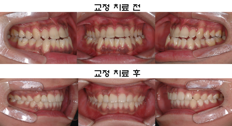 치아 부정교합 교정 증례