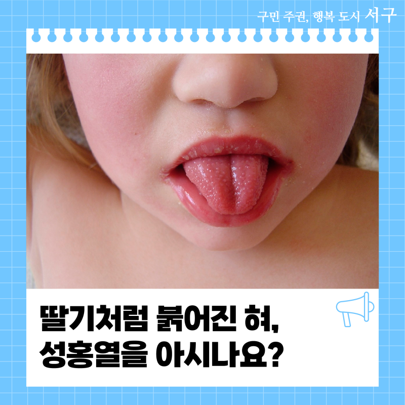 딸기처럼 붉어진 혀, 성홍열을 아시나요?