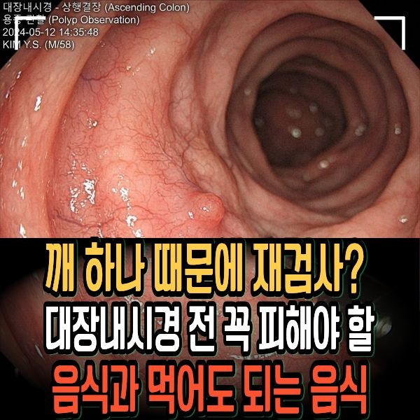 깨 하나 때문에 재검사?대장내시경 전 꼭 피해야 할 음식과 먹어도 되는 음식