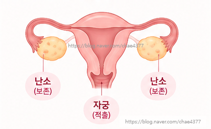 자궁 적출 후 난소 나이는 괜찮을까? AMH 수치와 호르몬 건강 관리법