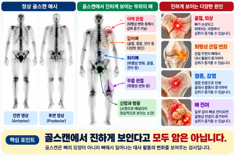 핵의학 이야기 9편 골스캔(BONE SCAN)에서 뼈가 진하게 보이는 이유는 무엇일까?