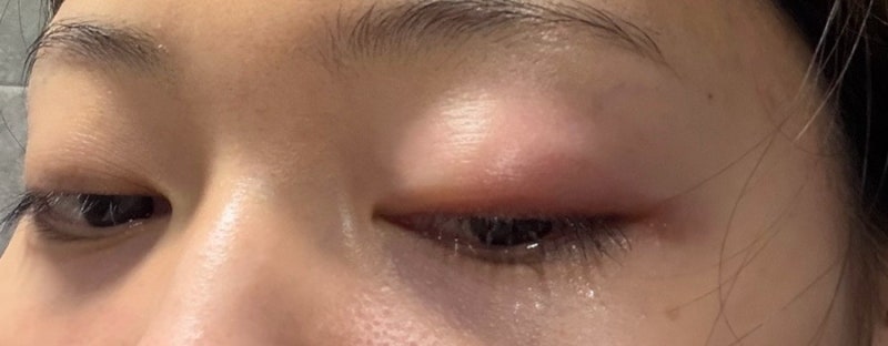 속다래끼 째기 후기 :: 역대급 통증과 눈두덩이 붓기 회복 과정 생생후기