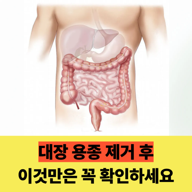 대장용종 제거 후 주의사항, 이것만은 꼭 확인하세요