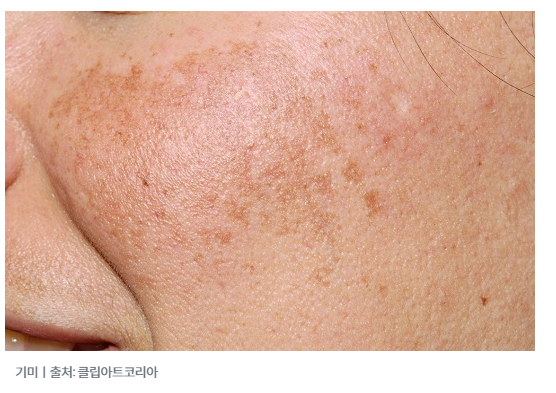 기미 검버섯 진짜 없애고 싶으세요? 레이저를 해봤자 또 생기는 이유
