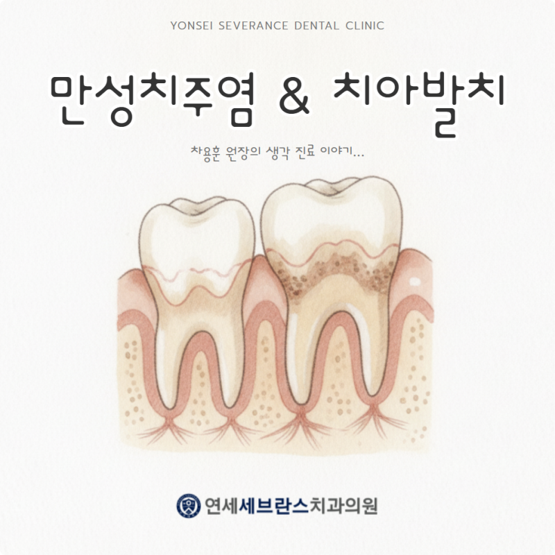 만성치주염 방치하면, 발치로 이어질 수도 있습니다