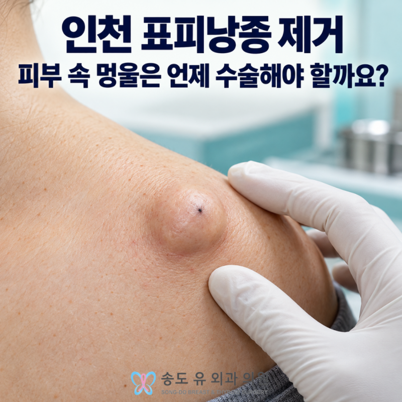 인천 표피낭종 제거, 피부 속 멍울은 언제 수술해야 할까요?