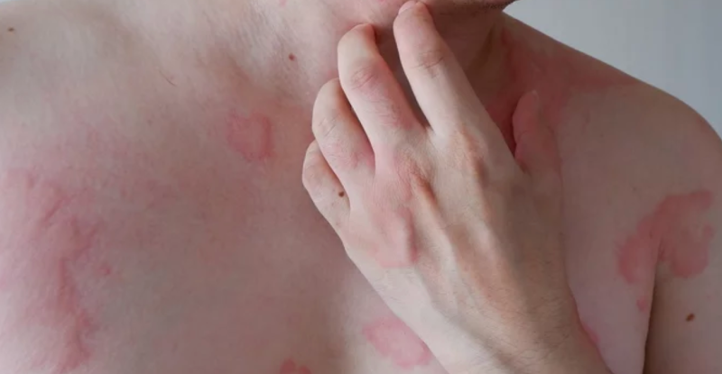 두드러기 약을 먹어도 계속 반복된다면? 원인부터 치료까지