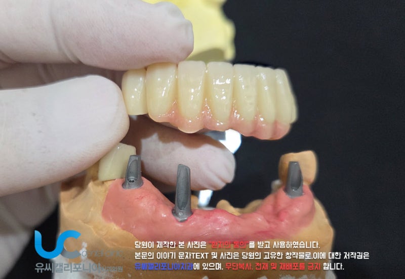 미아역 치과, 아래앞니 임플란트 브릿지 종류와 과정 임시치아 비용은 어떻게?