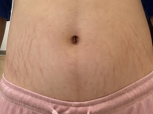 출산 후 튼살 자리에 연고 꾸준히 발라 관리했던 방법