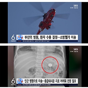 리튬건전지 아기 헬기 이송 9개월•2시간 이면 장기 녹이고 파열 까지..위험한 동전형 건전지