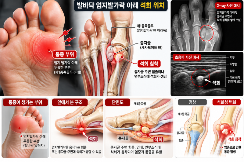 발바닥 석회 통증 원인과 치료 후기｜엄지발가락 아래 앞꿈치 석회, 체외충격파·스테로이드....