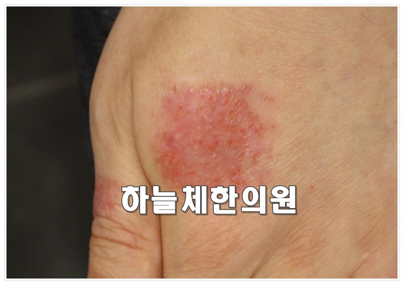 화폐상습진이 여러 개로 번진다면? 대전 하늘체에서 습진 원인과 증상별 관리방법 알려드립....
