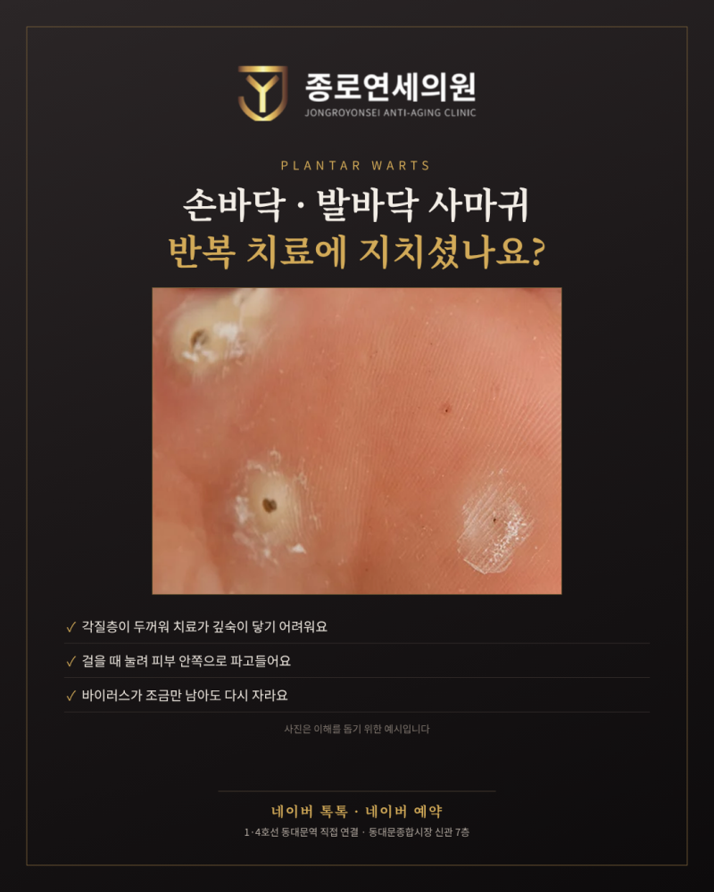 손바닥·발바닥 사마귀, 냉동치료·레이저로도 안 낫는다면? 수술적 제거｜동대문역 종로연....