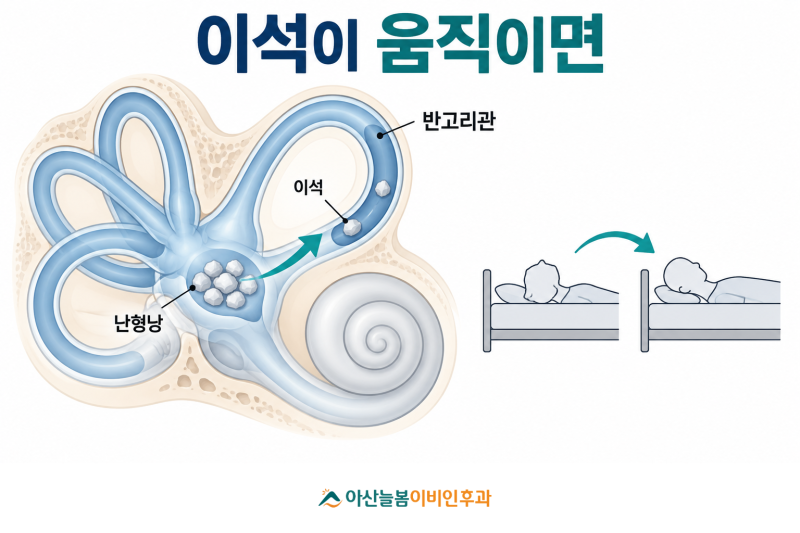 군포 산본 이석증, 침대에서 돌아누울 때 어지럽고 재발했다면