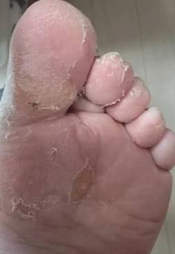 바르지오 모두크림 발바닥 무좀 효과 다 느껴보고 내린 결론!