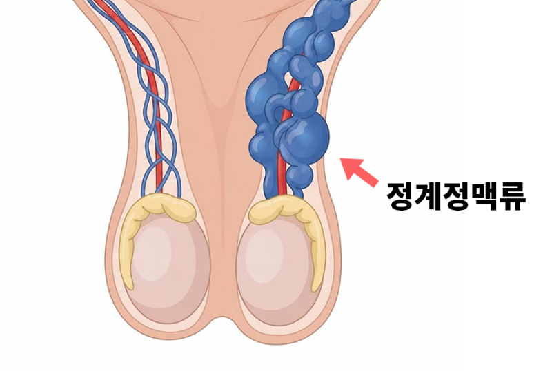 자연치유 안되는 정계정맥류, 적극적 치료가 필요한 3가지 증상