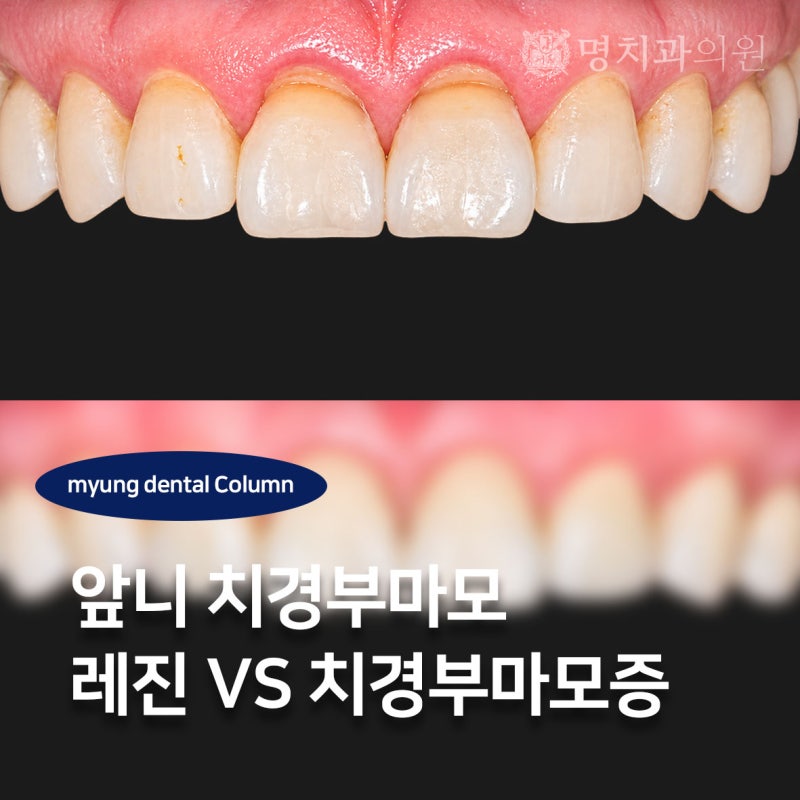 경산 중산 치과 치경부마모증 레진 G.I 비용만 차이일까?