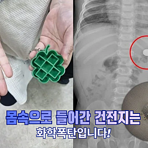 "단 2시간 만에 구멍이…" 생후 9개월 아기가 삼킨 동전 건전지