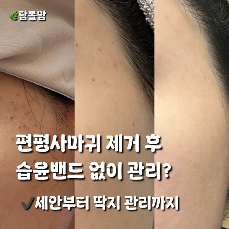 편평사마귀 제거 후 관리 후기｜습윤밴드 없이 9일차 딱지 탈락