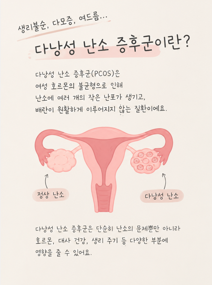 다낭성 난소 증후군 임신 준비, 증상부터 배란 관리까지 알아보기