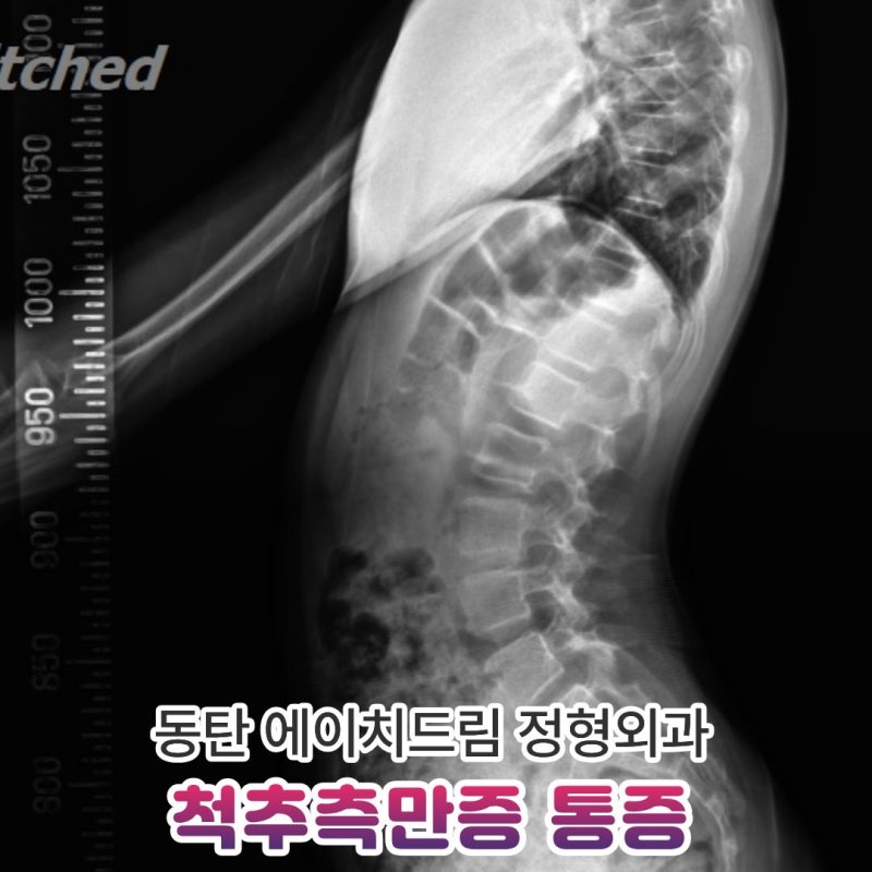 척추측만증 통증, 원인부터 관리까지 3가지 핵심 정리