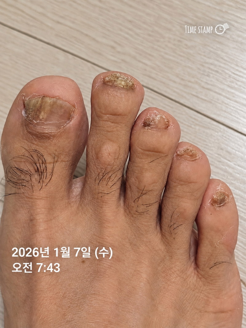발톱무좀약 종류 추천｜주블리아·풀케어·로세릴 사용법·비용·장단점 비교