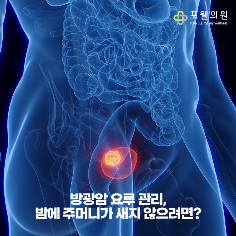 방광암 요루 관리, 밤에 주머니가 새지 않으려면?