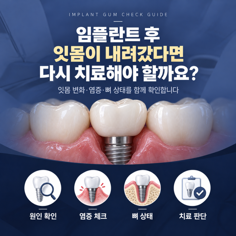 군자역치과 임플란트 후 잇몸이 내려갔다면 다시 치료해야 할까요?