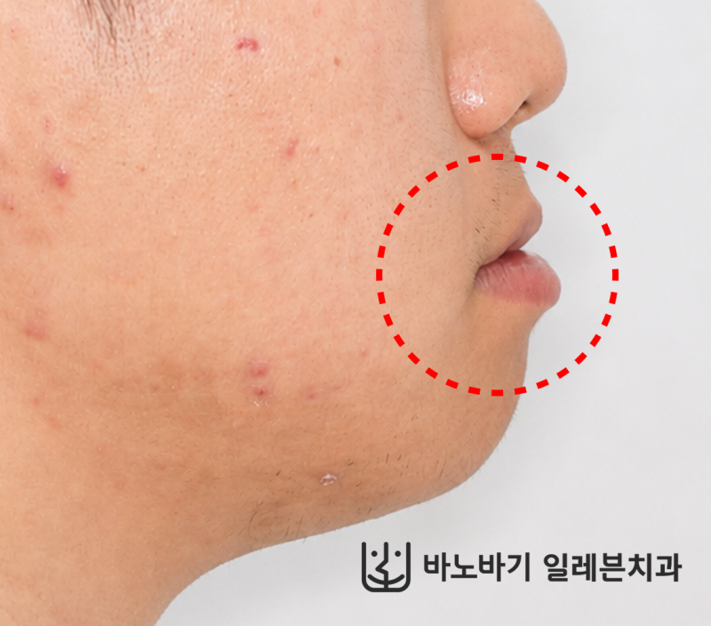 비수술 주걱턱 교정, 얼굴이 얼마나 달라지나요? (20대 성인 남자분 진료 후기)
