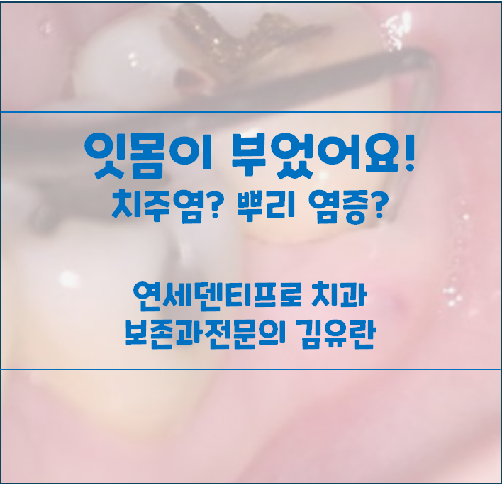 잇몸이 부었어요. 치주염일까, 치아 뿌리 염증일까?